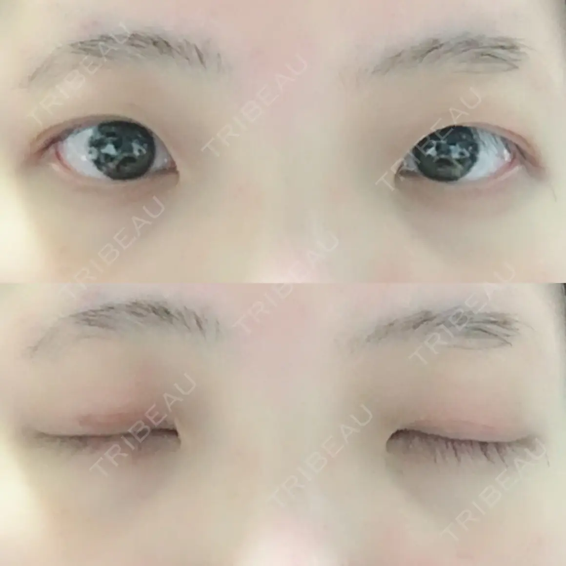二重切開 TANAKAクリニック形成外科・美容外科 AFTER