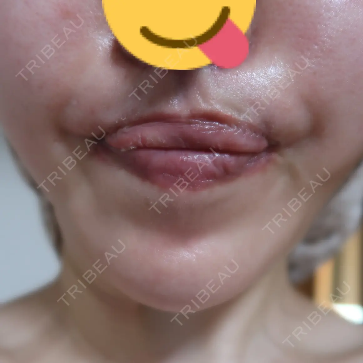 ボトックス（あご） 湘南美容クリニック 新宿南口院 AFTER