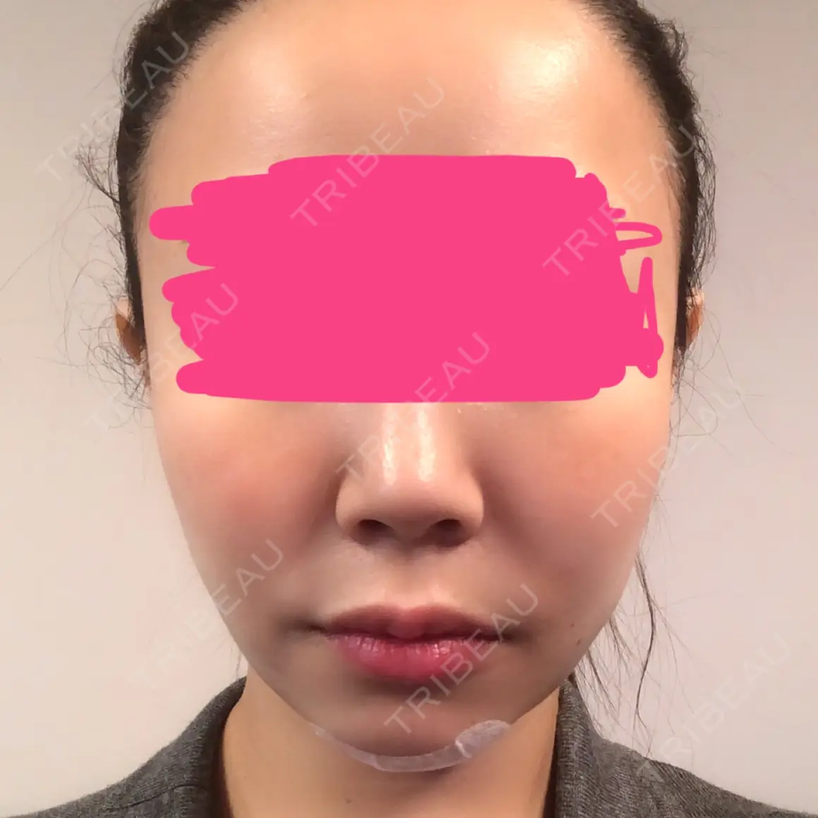 脂肪吸引（顔） 藤・ナチュレ美容クリニック 恵比寿院 DAY 0