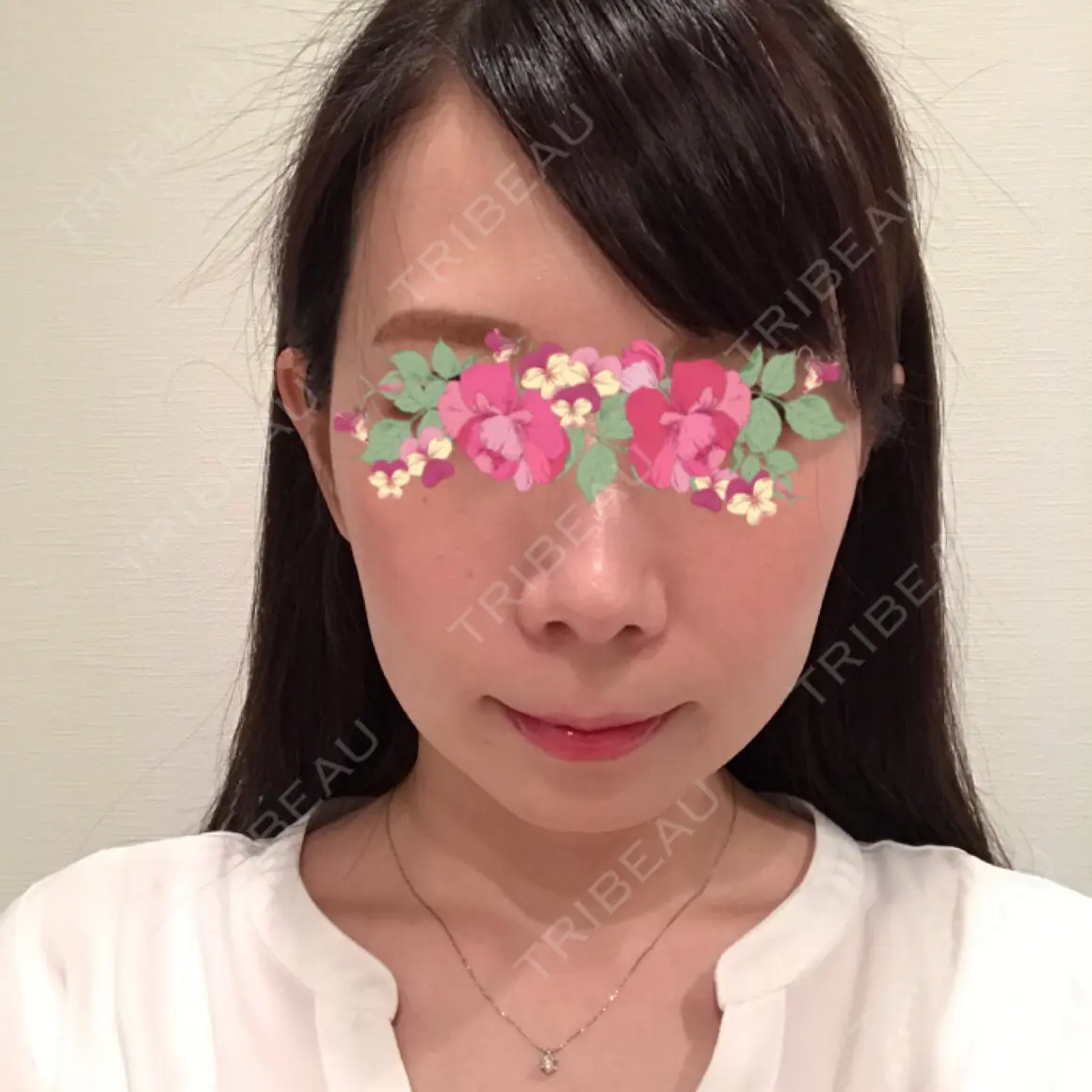 ハイフ（顔） 東京美容皮膚科CLINIC AFTER
