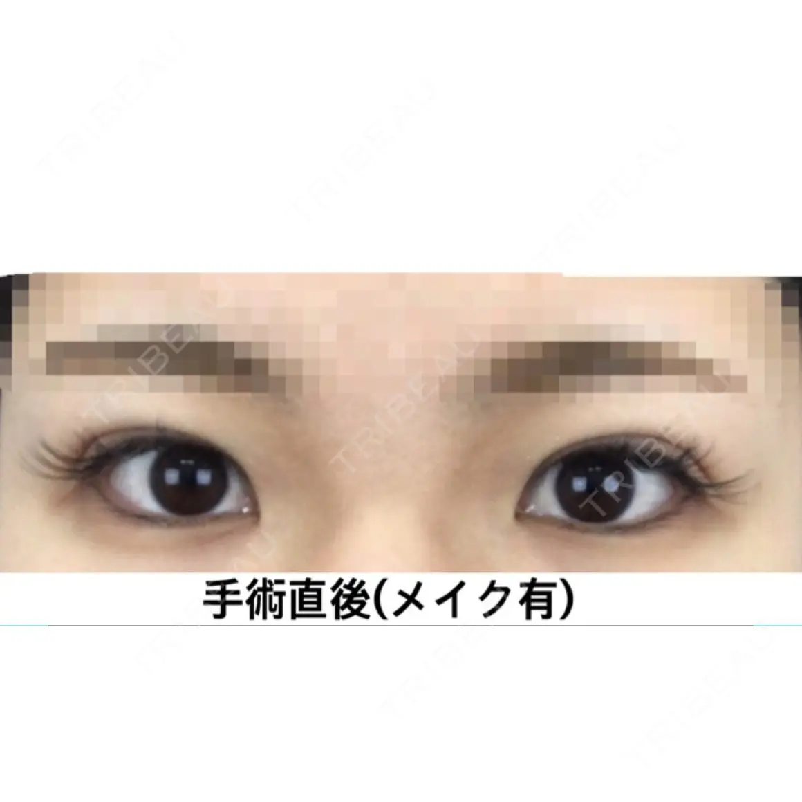 二重埋没 湘南美容クリニック 新宿本院 DAY 0