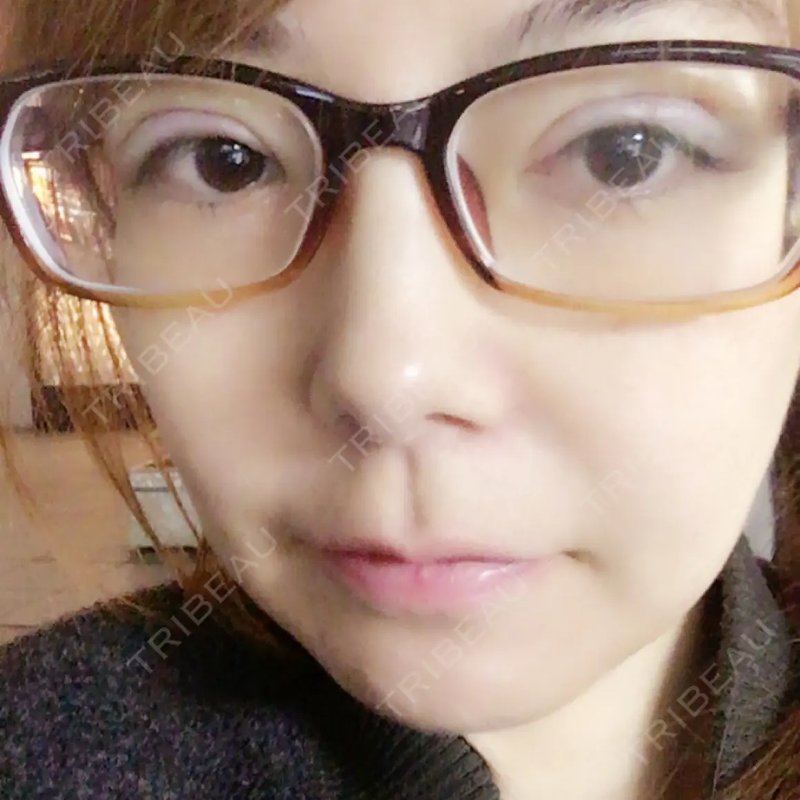 二重切開 高須クリニック 名古屋院 DAY 0
