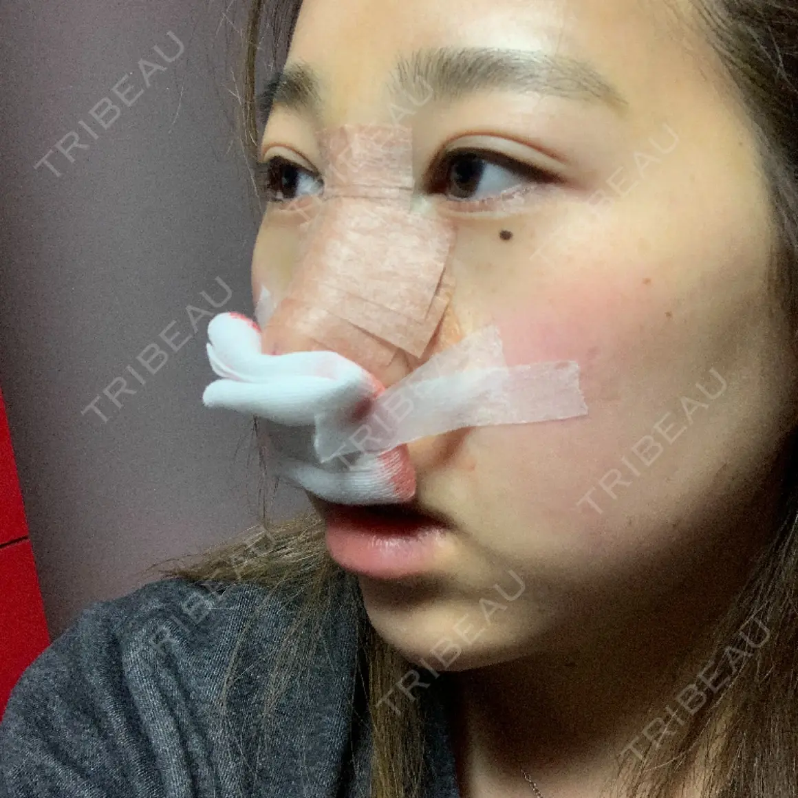 隆鼻術 / 鼻尖形成（切開） / 鼻中隔延長（切開） リエンジャン整形外科 江南店 DAY 0
