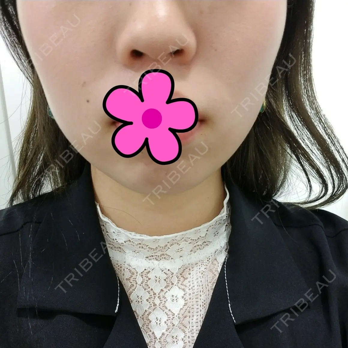 ボトックス（エラ・小顔） 湘南美容クリニック 新宿南口院 DAY 0