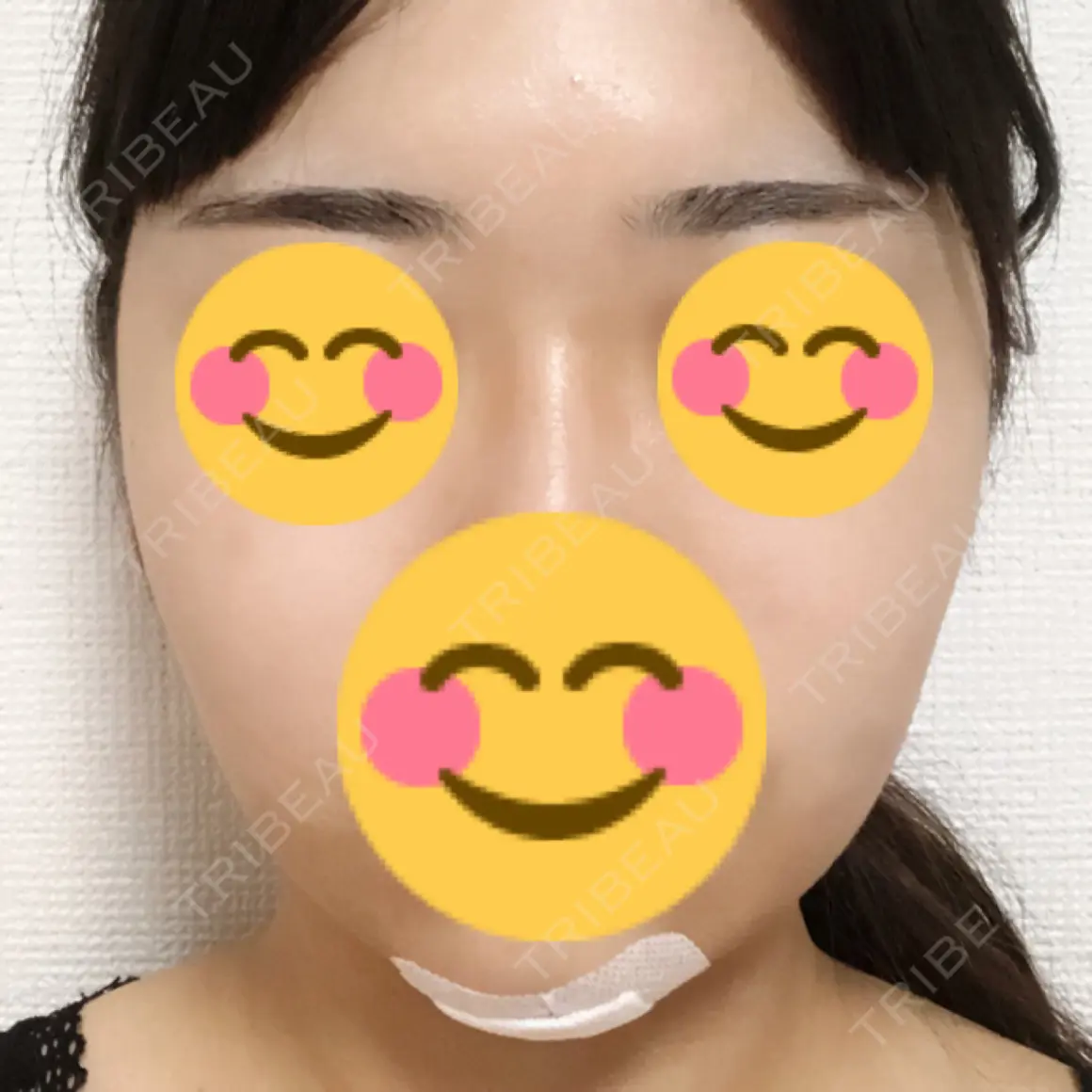 バッカルファット除去 / 脂肪吸引（顔） / ボトックス（エラ・小顔） 藤・ナチュレ美容クリニック 恵比寿院 DAY 0