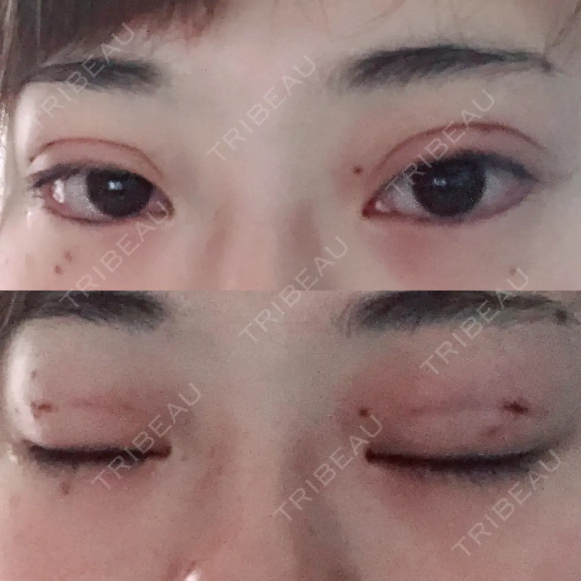 二重埋没 / 上まぶたの脂肪取り 湘南美容クリニック 柏院 DAY 0