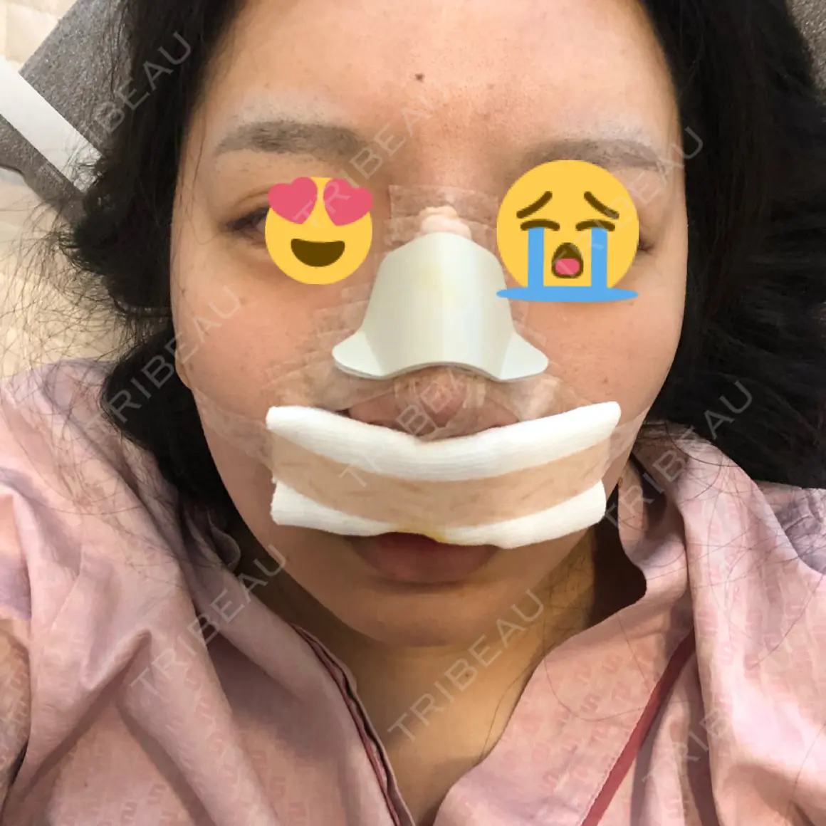 隆鼻術 / 鼻尖形成（切開） / 鼻中隔延長（切開） / 骨切幅寄せ / 眉間プロテーゼ / プロテーゼ除去 / 鼻尖縮小 FROM B整形外科 (旧バウム整形外科) DAY 0