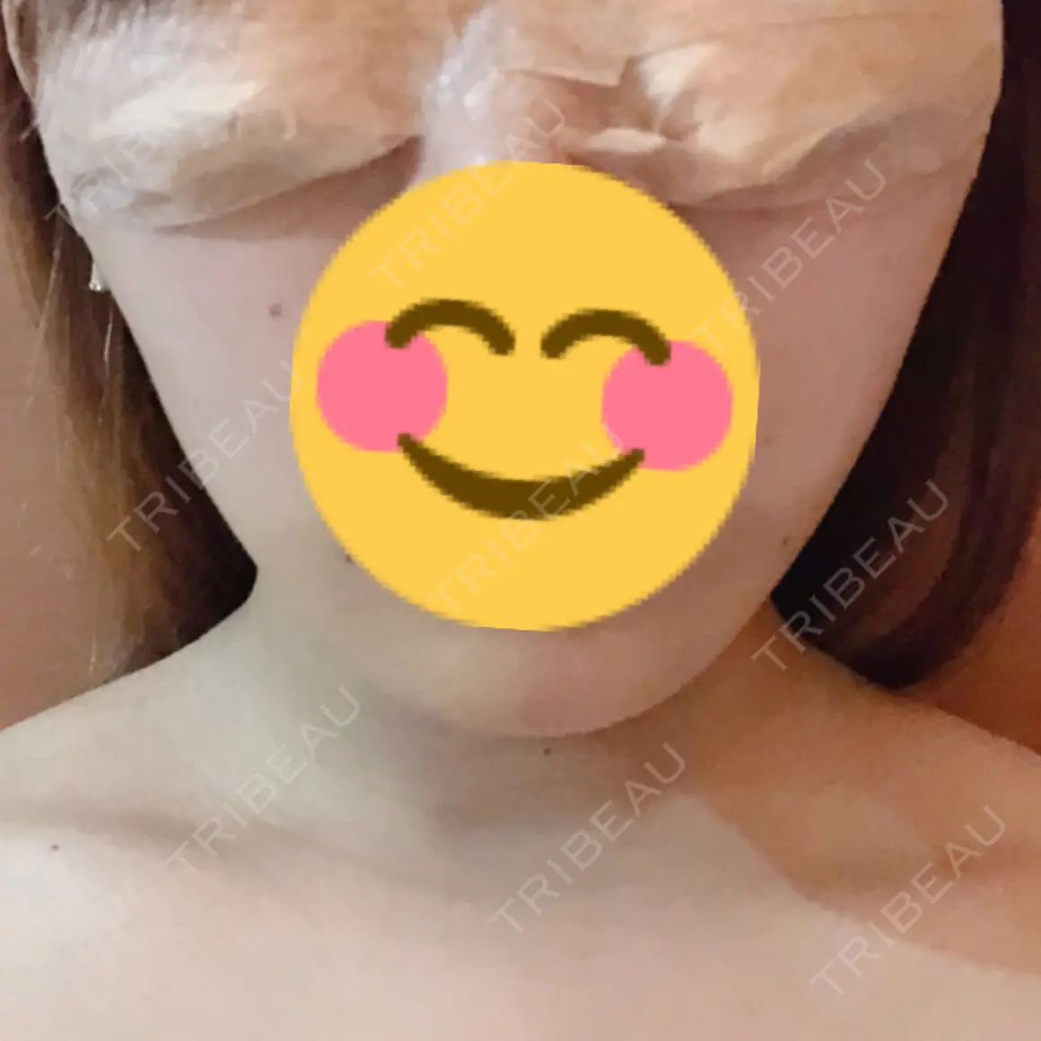 バッカルファット除去 / 脂肪吸引（顔） / 水光注射（ハリ・美肌） / ボトックス（エラ・小顔） エートップ美容整形外科 AFTER
