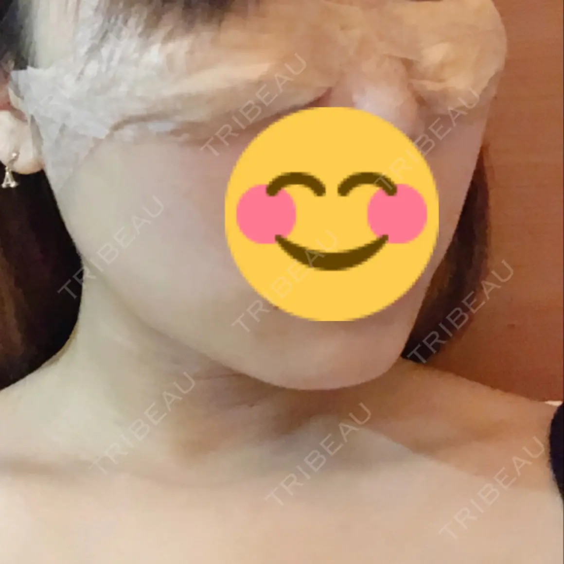 バッカルファット除去 / 脂肪吸引（顔） / 水光注射（ハリ・美肌） / ボトックス（エラ・小顔） エートップ美容整形外科 AFTER