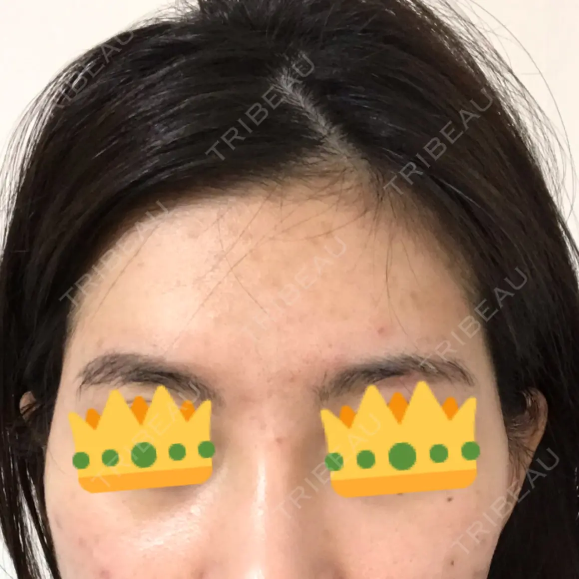 額を丸く / 脂肪注入（額） / 脂肪注入（輪郭） ザ・プラス美容外科 AFTER