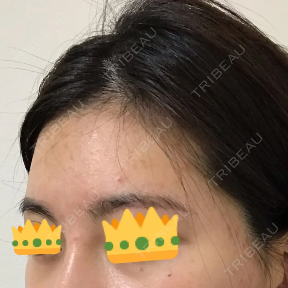 額を丸く / 脂肪注入（額） / 脂肪注入（輪郭） ザ・プラス美容外科 AFTER