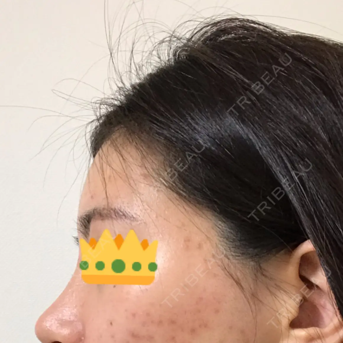 額を丸く / 脂肪注入（額） / 脂肪注入（輪郭） ザ・プラス美容外科 AFTER