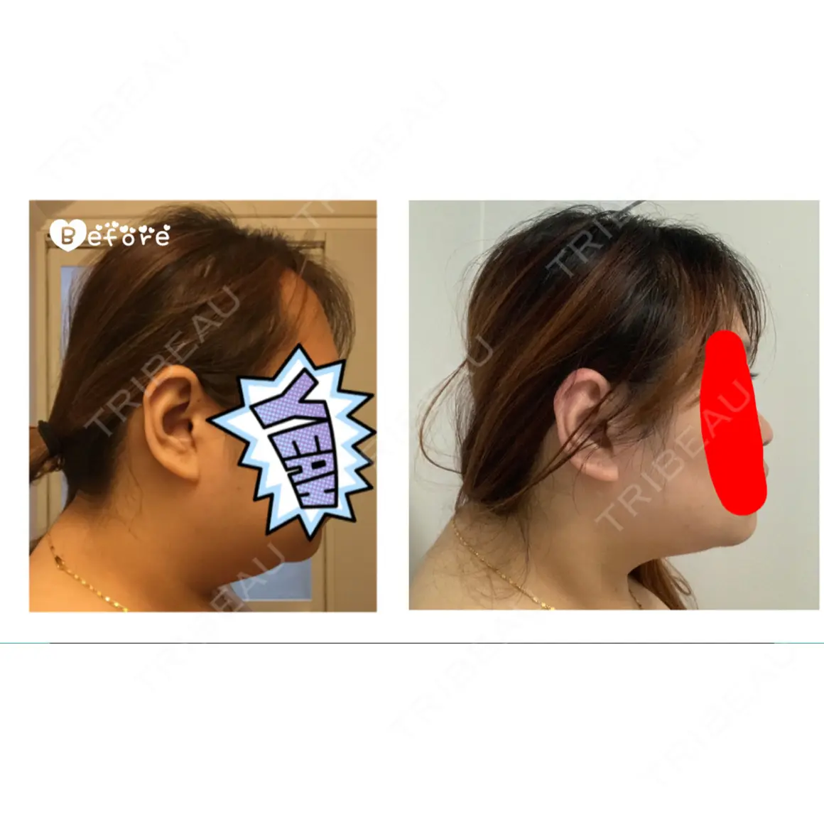 脂肪吸引（顔） アサミ美容外科 名古屋院 AFTER
