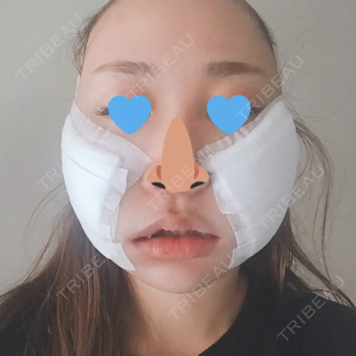 バッカルファット除去 / 脂肪吸引（顔） / ヒアルロン酸注入（あご） フレッシュ整形外科 DAY 0