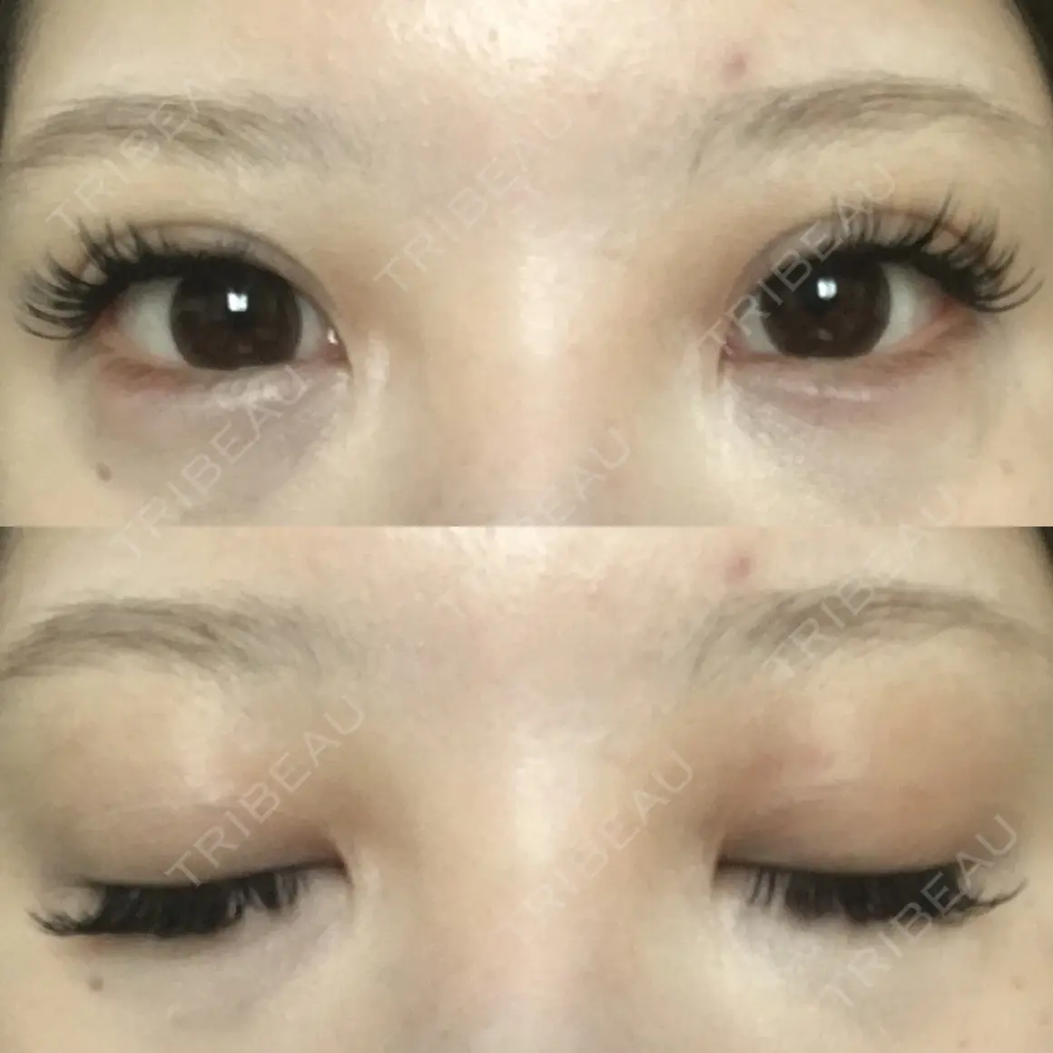 二重埋没 / ヒアルロン酸注入（涙袋） 湘南美容クリニック 札幌院 AFTER