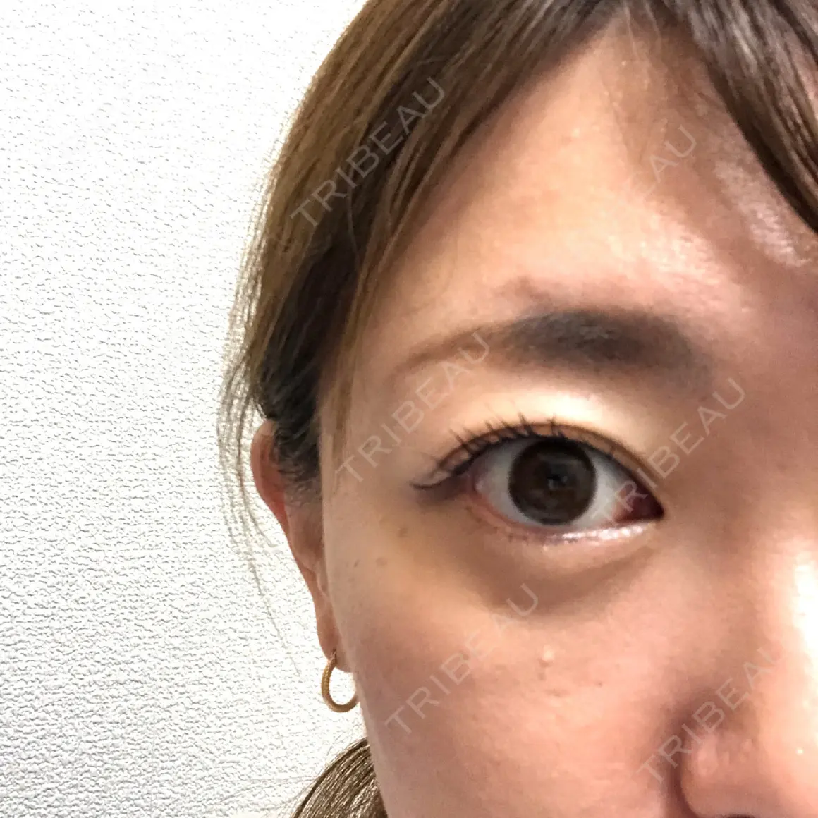 クマ治療 / 下まぶたの脂肪取り TCB東京中央美容外科 中野院 DAY 9