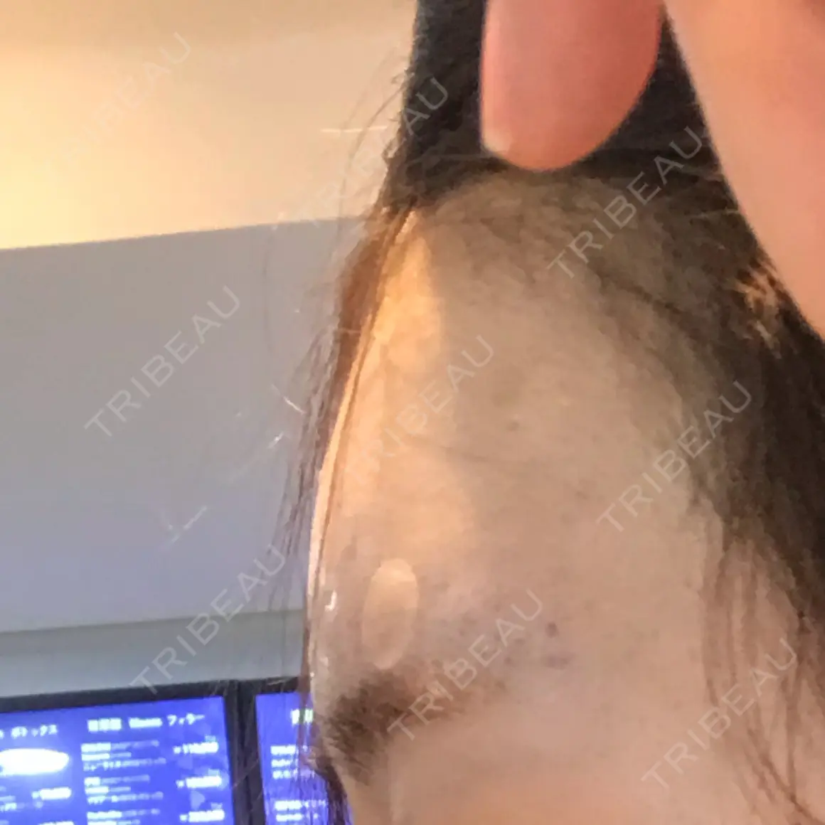 額を丸く / ヒアルロン酸注入（額） エートップ美容整形外科 DAY 0