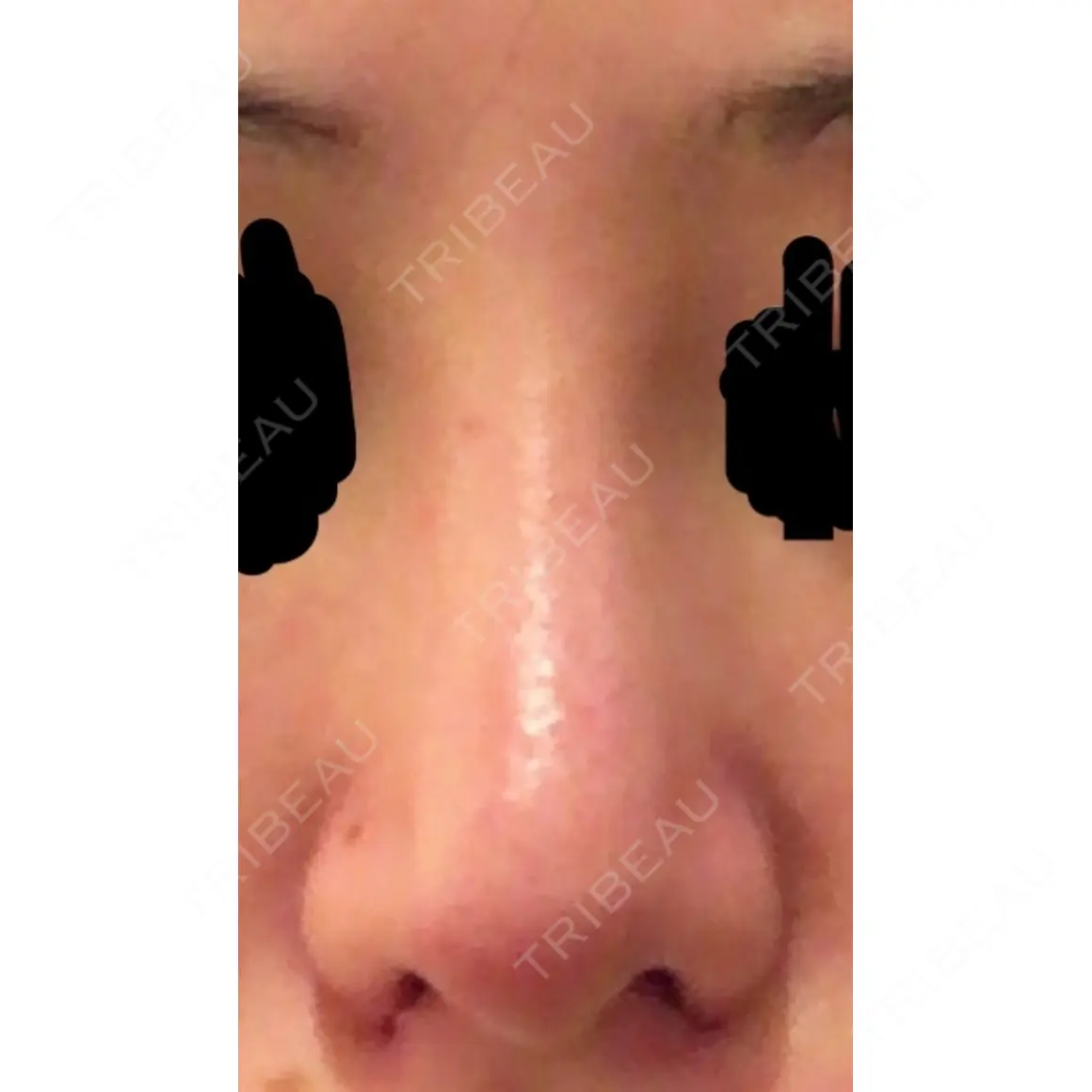小鼻縮小（切開） 聖心美容クリニック 六本木院 DAY 0