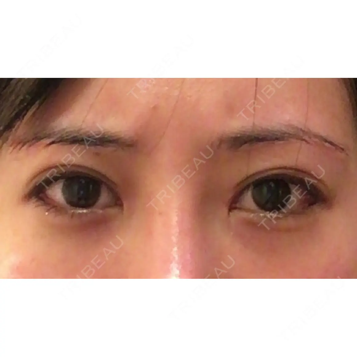 目尻切開 聖心美容クリニック 六本木院 DAY 0