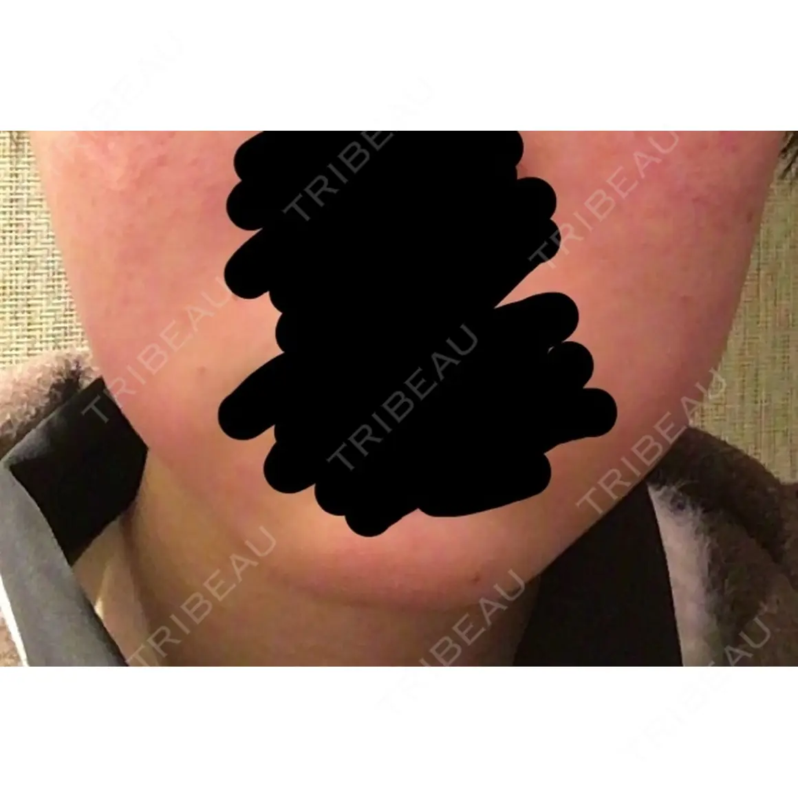 脂肪溶解注射（顔） 聖心美容クリニック 六本木院 DAY 0