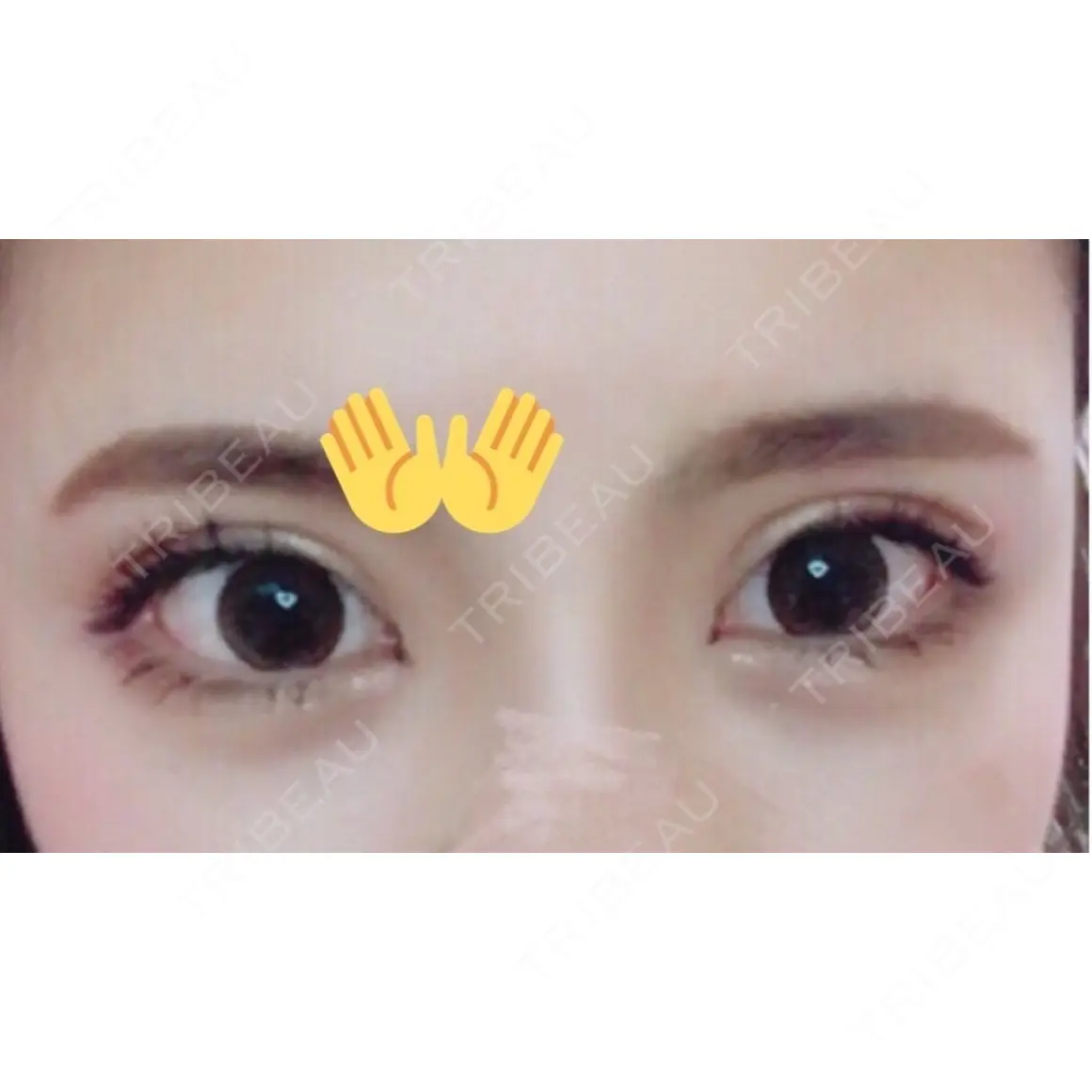 二重切開 / 目頭切開 / 眼瞼下垂（切開） / 目尻切開 / 上まぶたたるみ取り / ヒアルロン酸注入（涙袋） ジュエリー美容外科 DAY 145