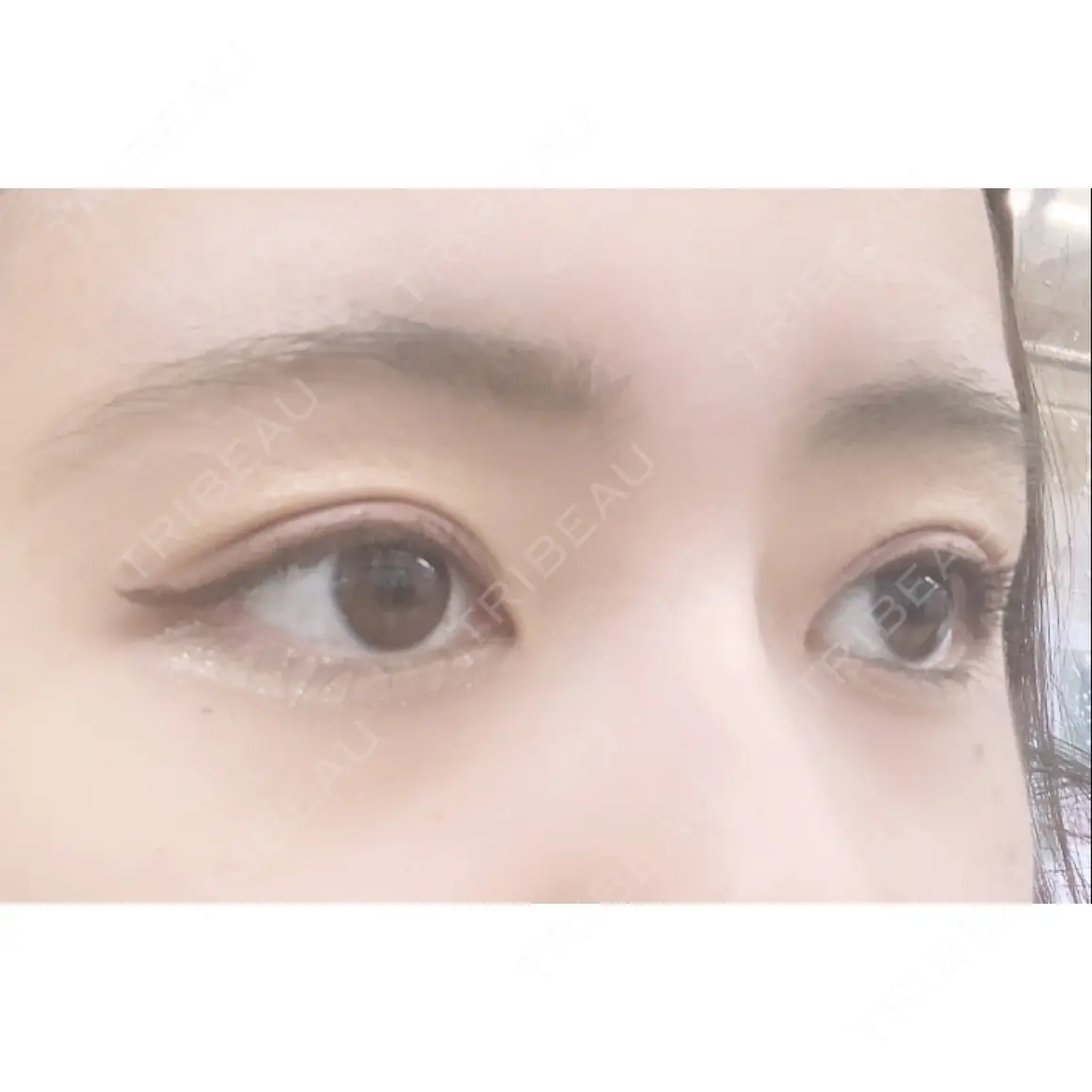 二重埋没 共立美容外科 新宿本院 AFTER