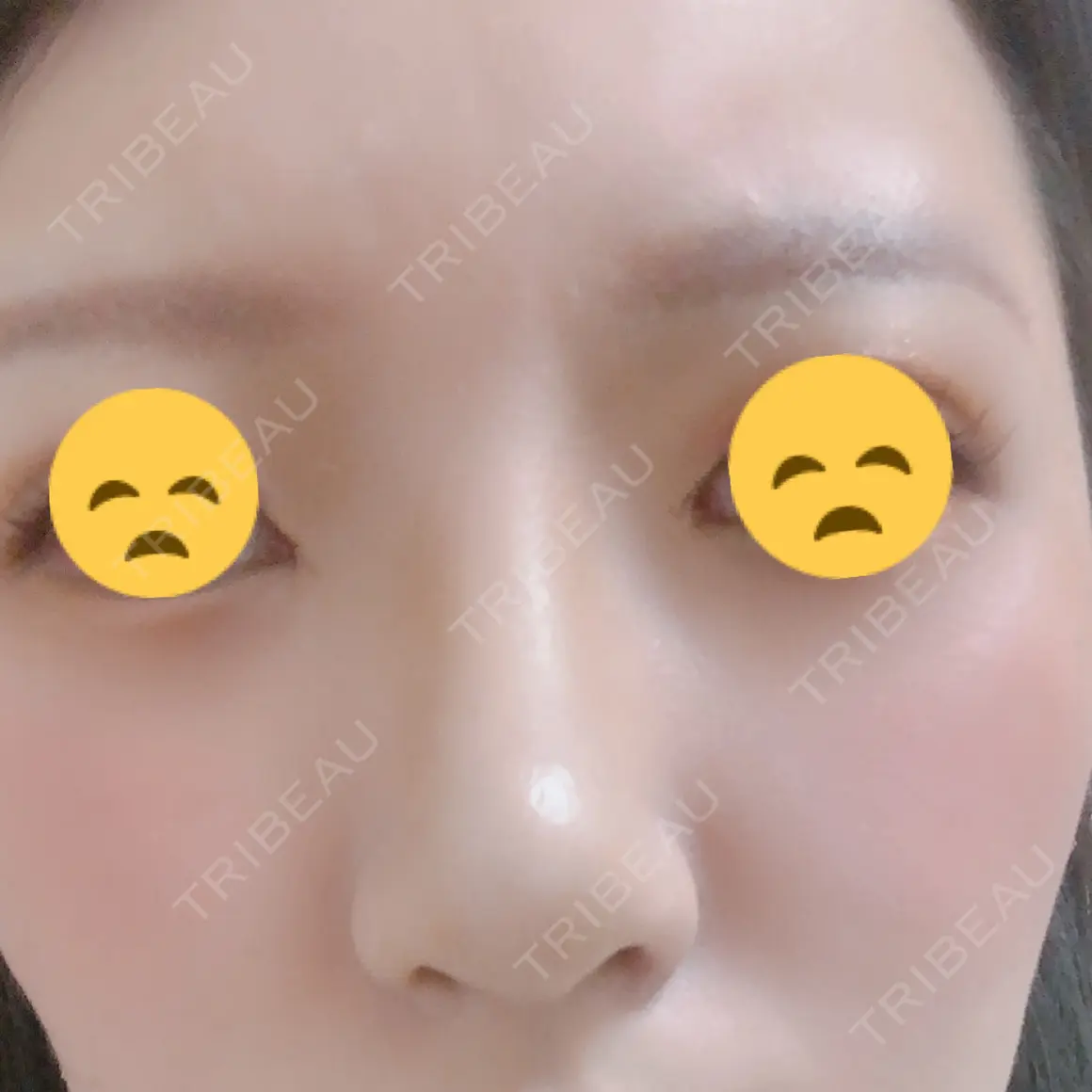 隆鼻術 / 鼻尖形成（切開） / 鼻中隔延長（切開） / 骨切幅寄せ / 眉間プロテーゼ / プロテーゼ除去 / 鼻尖縮小 FROM B整形外科 (旧バウム整形外科) AFTER
