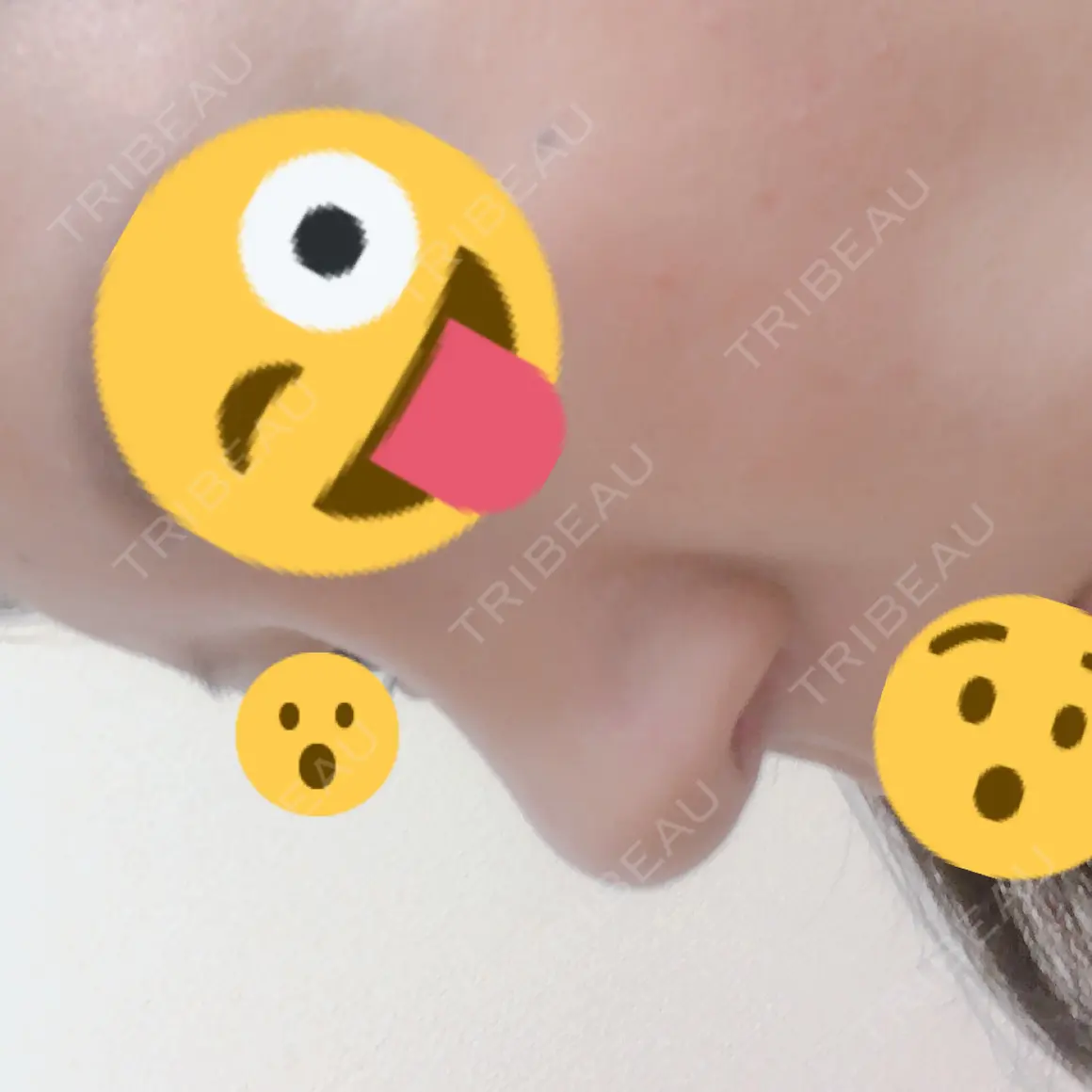 隆鼻術 / 鼻尖形成（切開） / 鼻中隔延長（切開） / 骨切幅寄せ / 眉間プロテーゼ / プロテーゼ除去 / 鼻尖縮小 FROM B整形外科 (旧バウム整形外科) AFTER