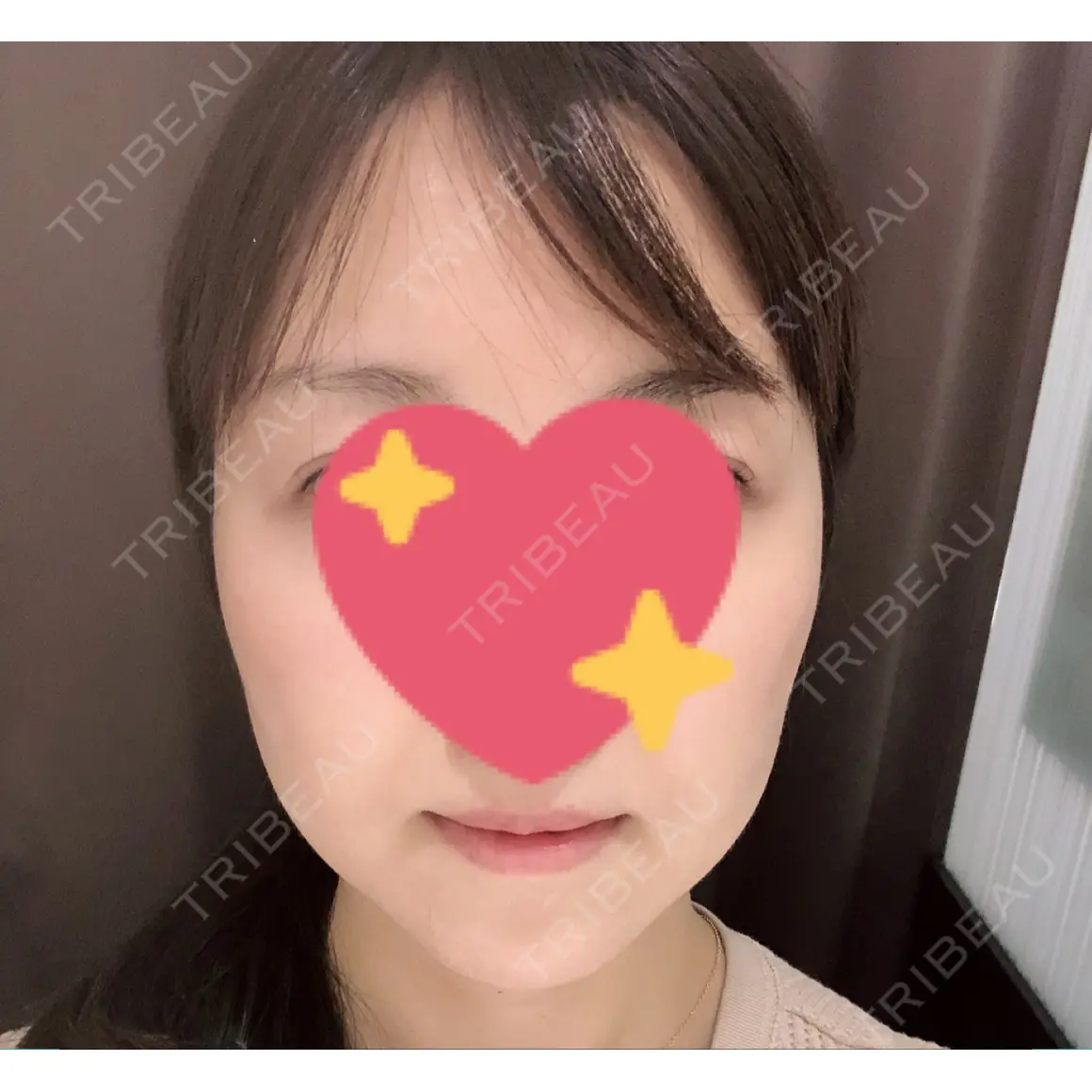 脂肪吸引（顔） / ボトックス（あご） / ヒアルロン酸注入（あご） 湘南美容クリニック 札幌院 AFTER