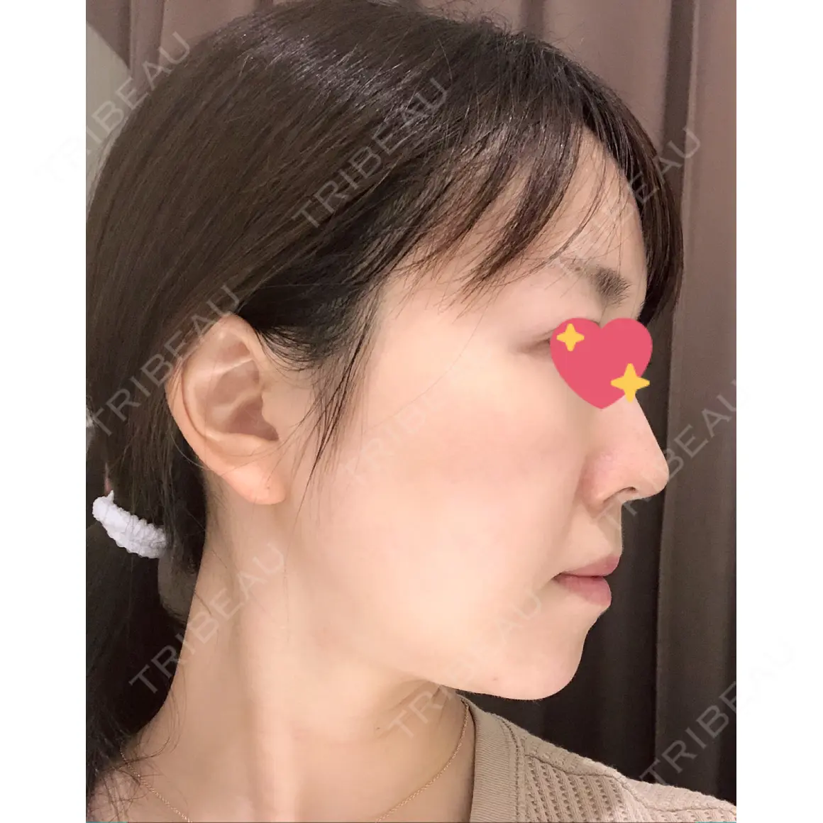 脂肪吸引（顔） / ボトックス（あご） / ヒアルロン酸注入（あご） 湘南美容クリニック 札幌院 AFTER