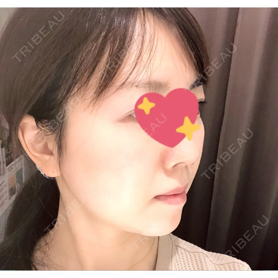 脂肪吸引（顔） / ボトックス（あご） / ヒアルロン酸注入（あご） 湘南美容クリニック 札幌院 AFTER