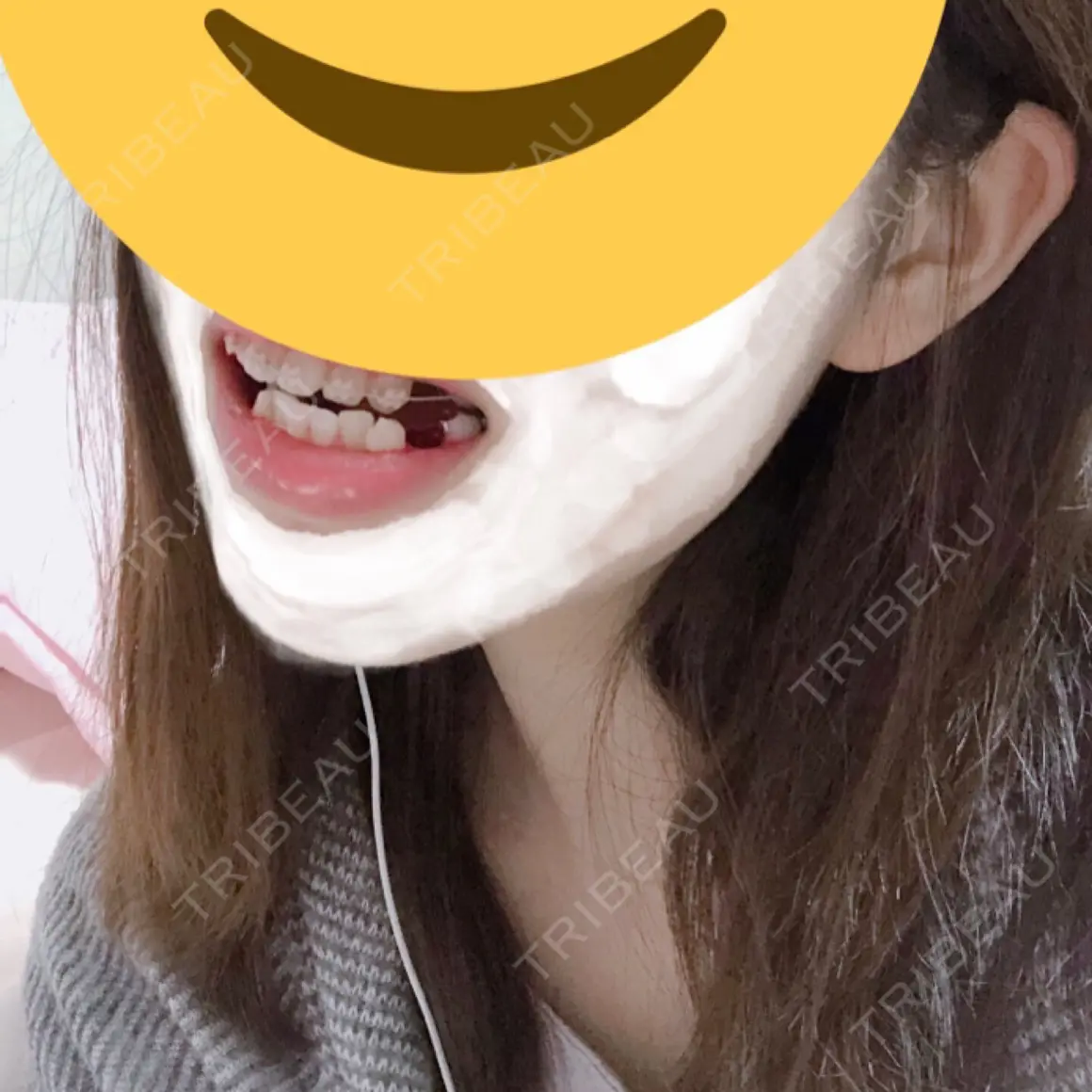 矯正（ワイヤー） ひがし矯正歯科クリニック DAY 16