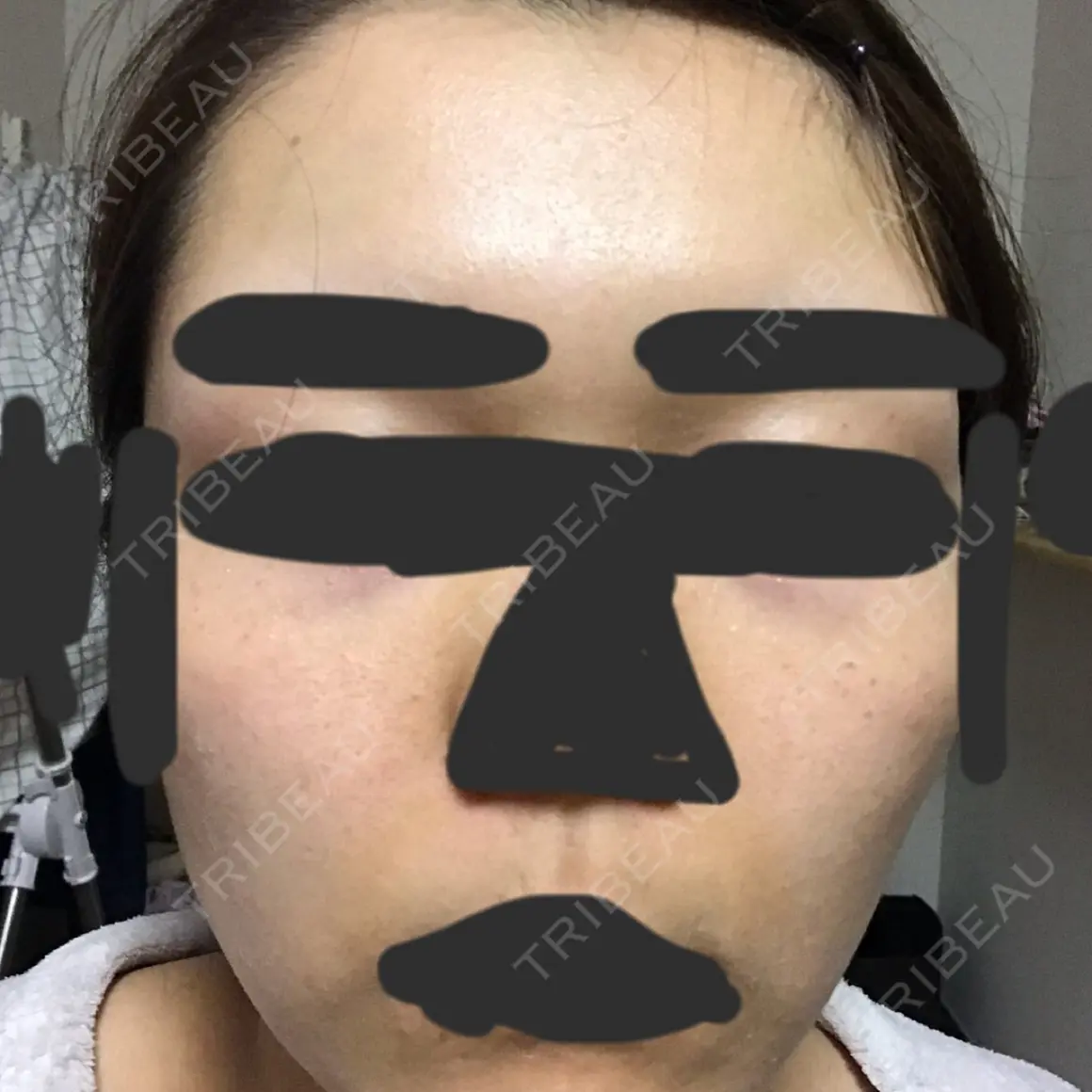 ほくろ・いぼ切除（肌） 高梨医院 皮膚科・美容皮膚科 AFTER