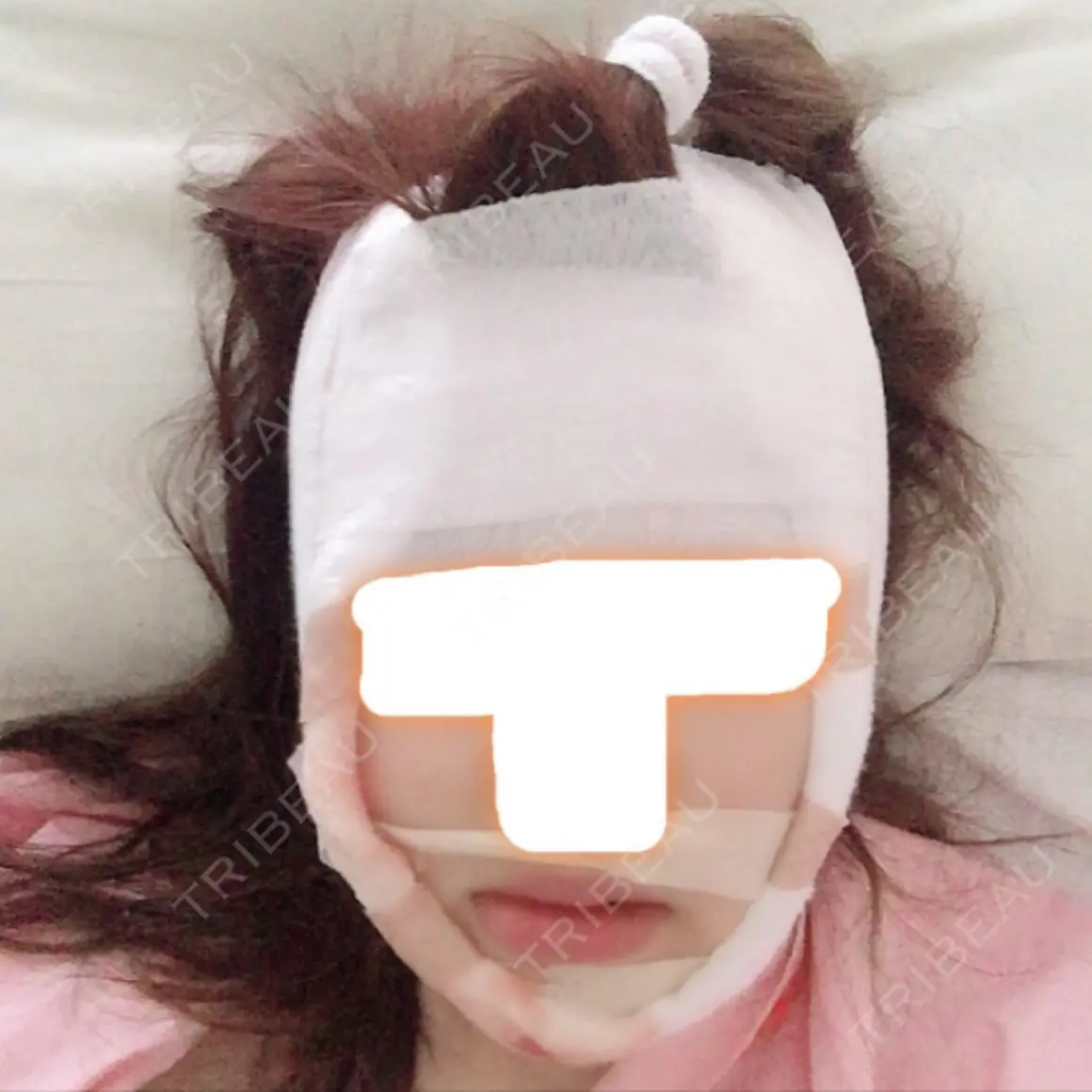 あごプロテーゼ / セットバック / その他（輪郭） / その他（審美歯科/矯正歯科） 大塚美容形成外科・歯科 大塚本院 DAY 0