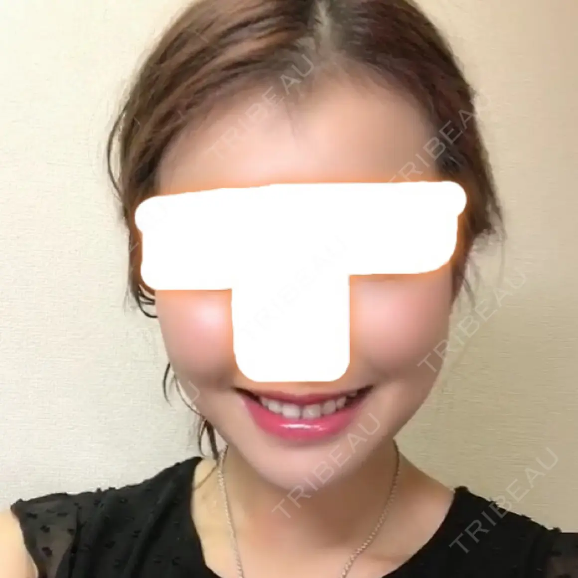 あごプロテーゼ / セットバック / その他（輪郭） / その他（審美歯科/矯正歯科） 大塚美容形成外科・歯科 大塚本院 AFTER