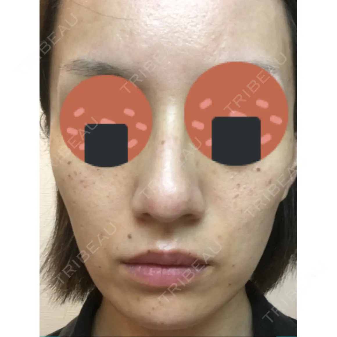 美肌レーザー / シミ取りレーザー / フォトRF 川崎中央クリニック DAY 0
