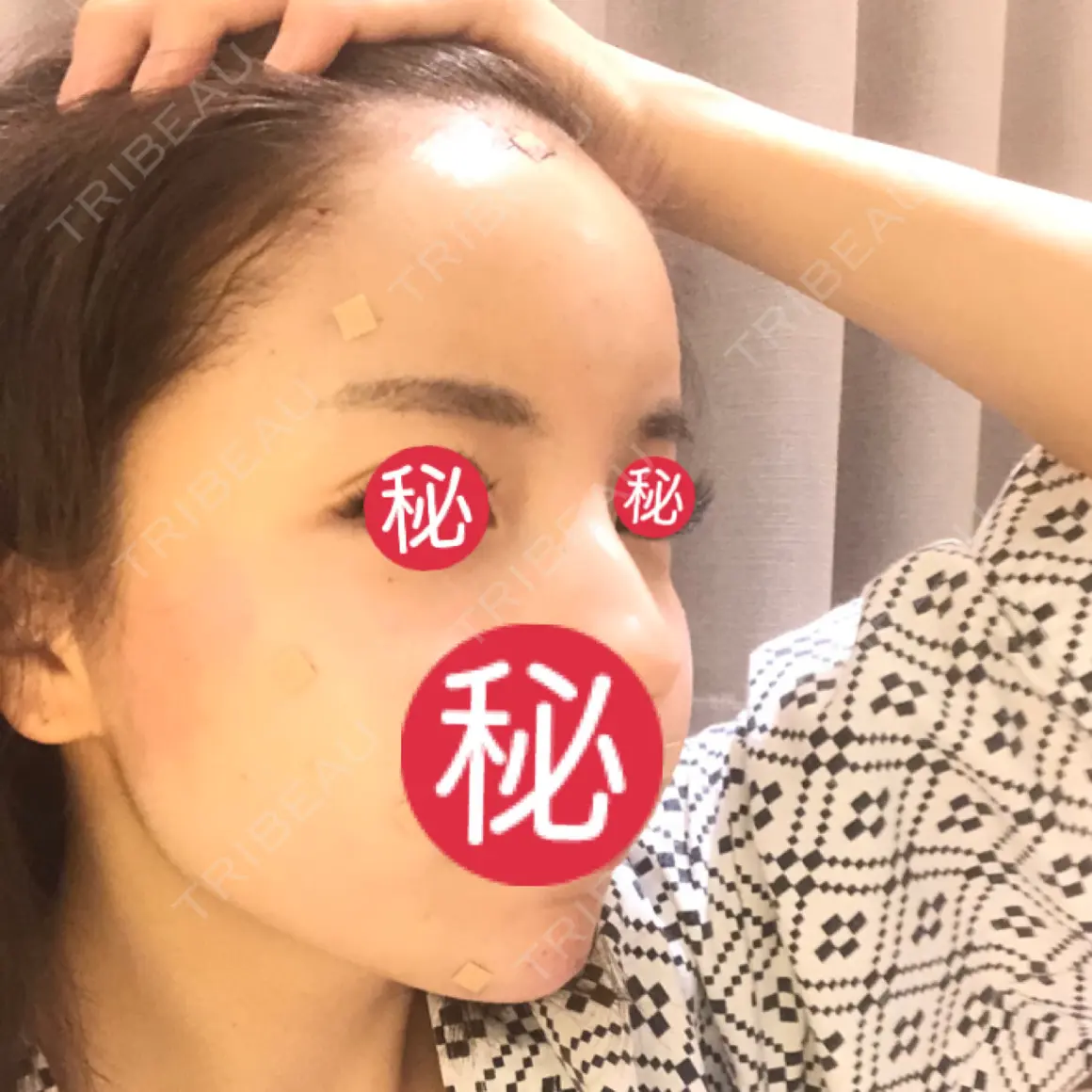 額を丸く / 脂肪注入（肌） / 脂肪注入（額） / 脂肪注入（輪郭） ジュエリー美容外科 DAY 0