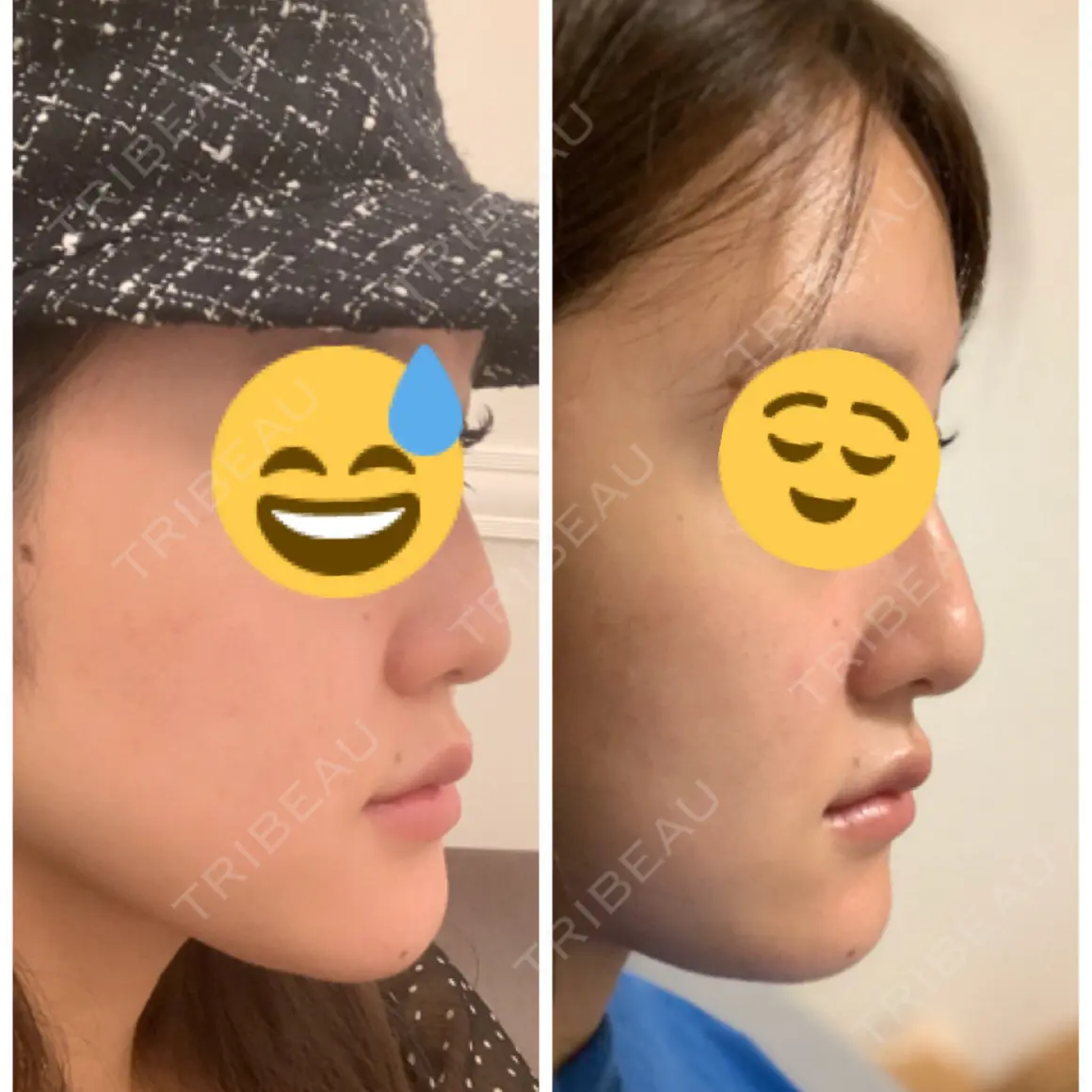 ボトックス（あご） BIANCA銀座 AFTER