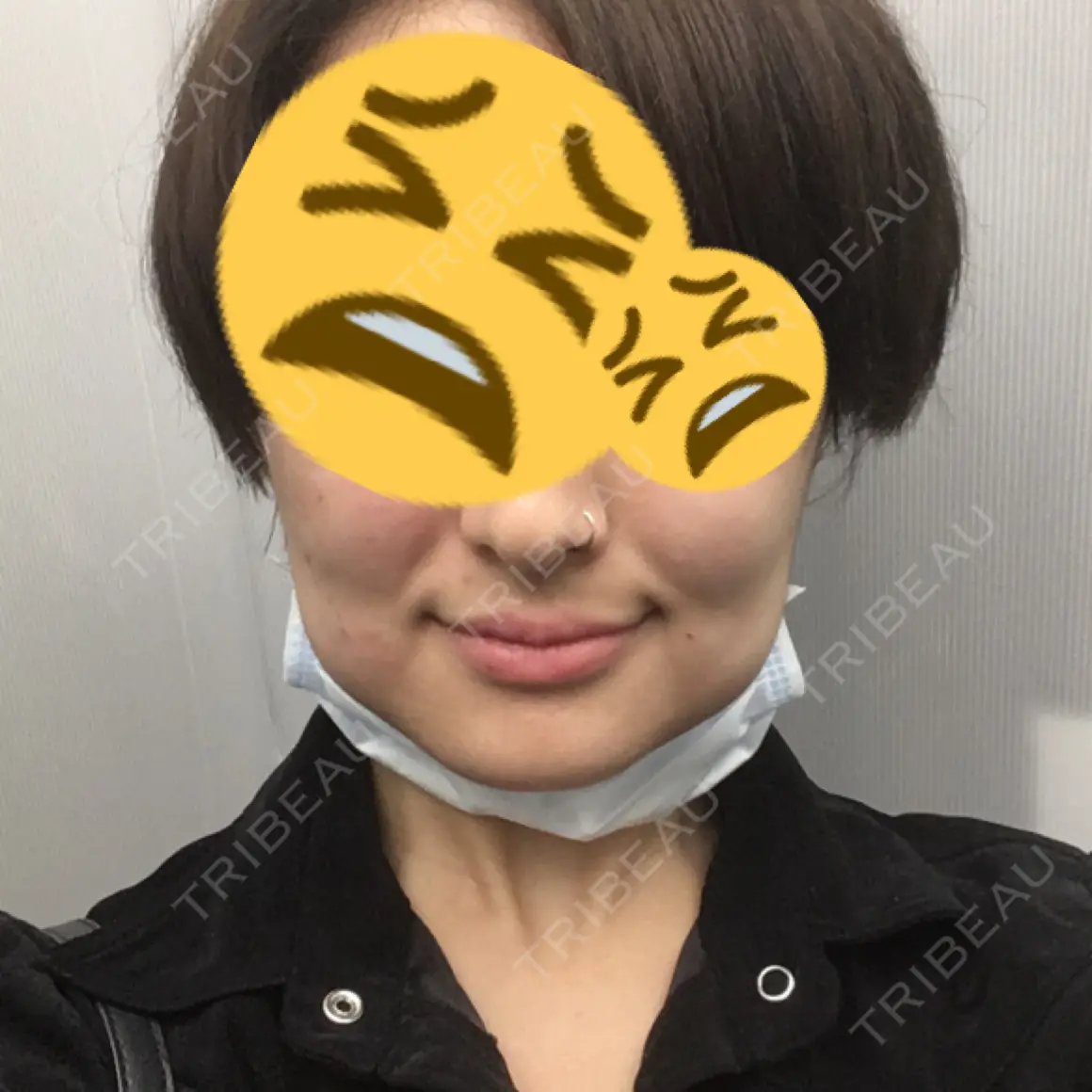 脂肪溶解注射（顔） 東京ロイヤルクリニック DAY 0