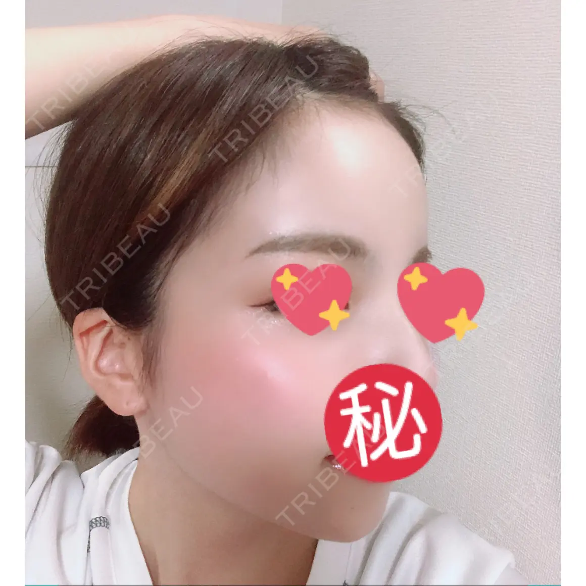 額を丸く / 脂肪注入（肌） / 脂肪注入（額） / 脂肪注入（輪郭） ジュエリー美容外科 AFTER