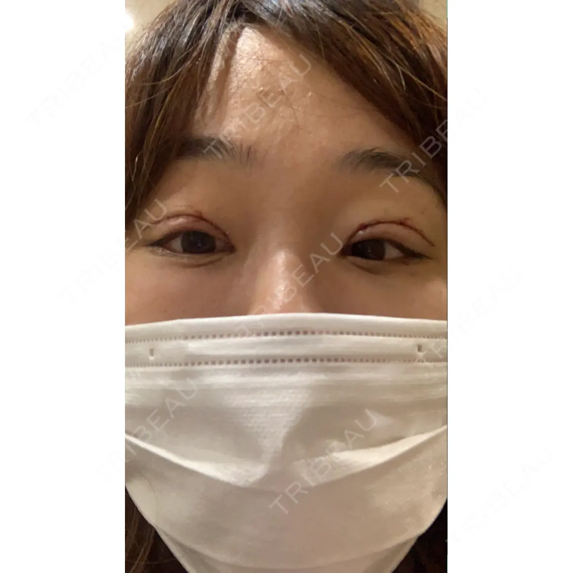 眼瞼下垂（切開） セオリークリニック DAY 0