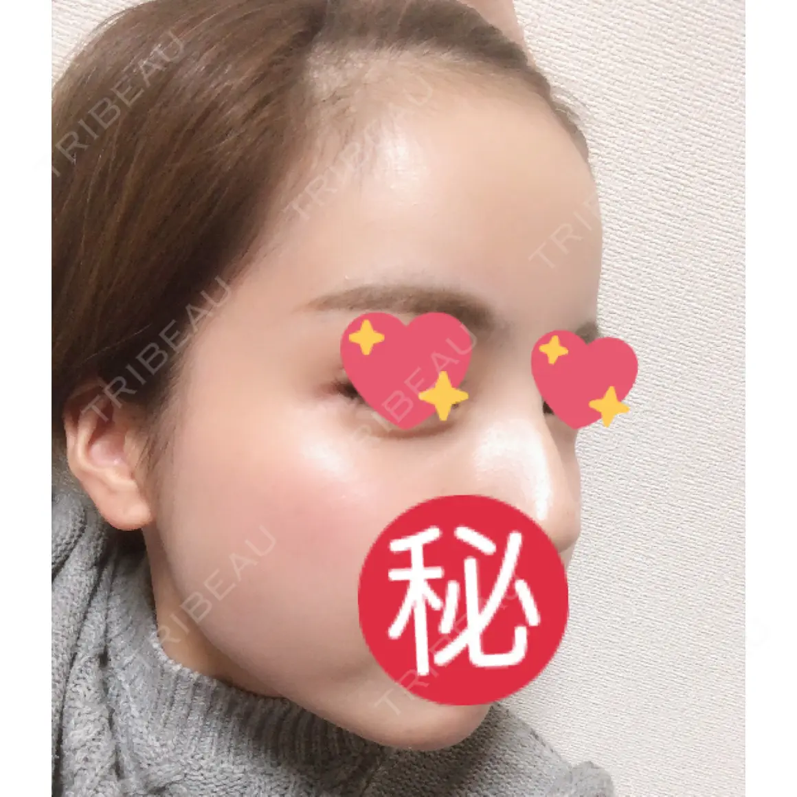 額を丸く / 脂肪注入（肌） / 脂肪注入（額） / 脂肪注入（輪郭） ジュエリー美容外科 AFTER