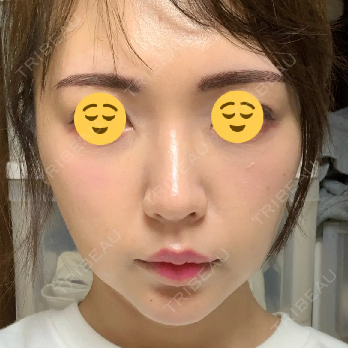 ハイフ（顔） / その他（輪郭） メイドユー皮膚科江南店 DAY 1