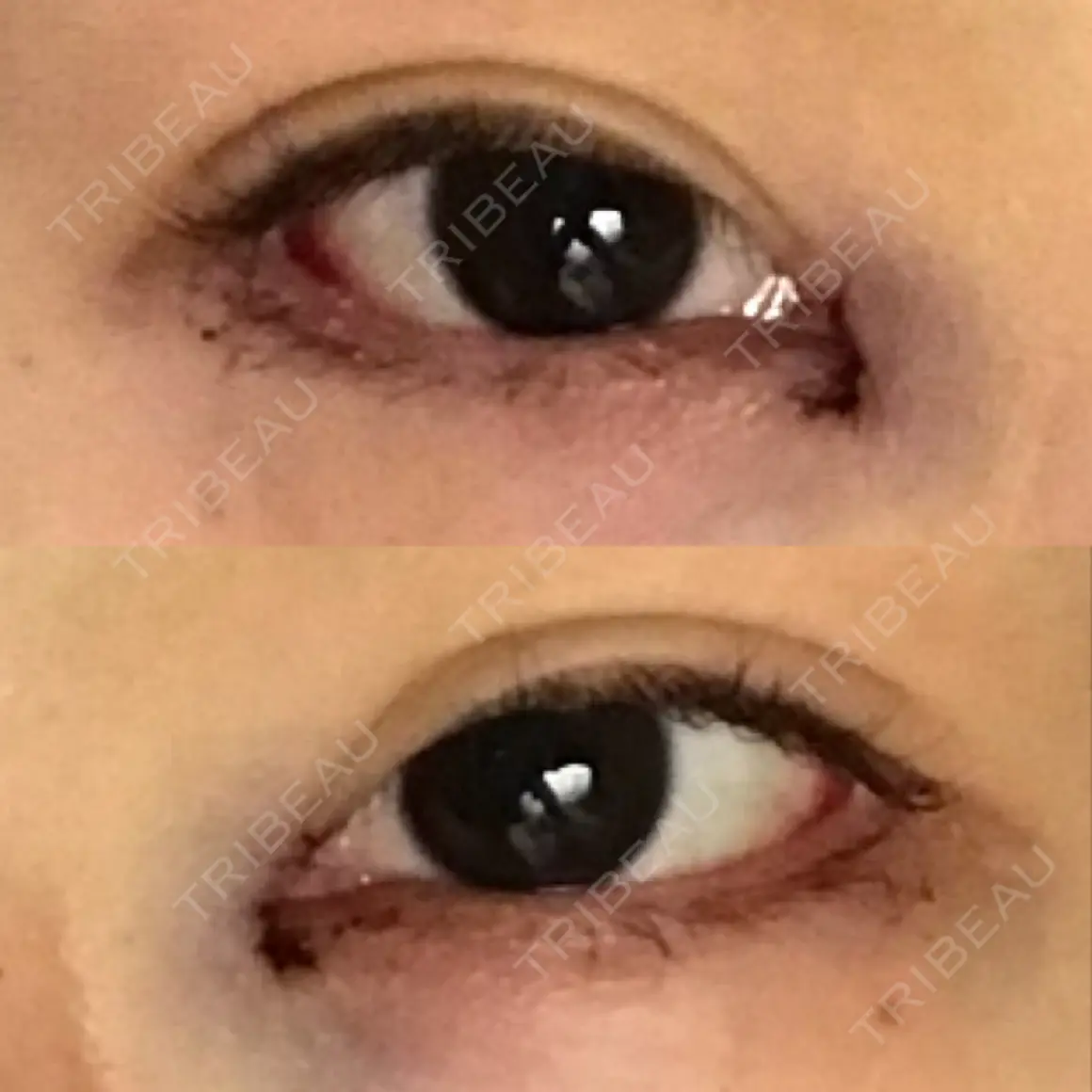 目頭切開 / タレ目形成・グラマラスライン（切開） エートップ美容整形外科 DAY 0