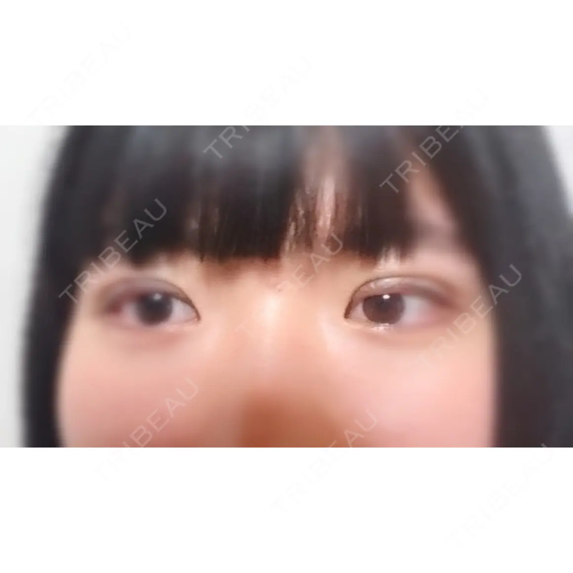 二重埋没 共立美容外科 札幌院 DAY 0