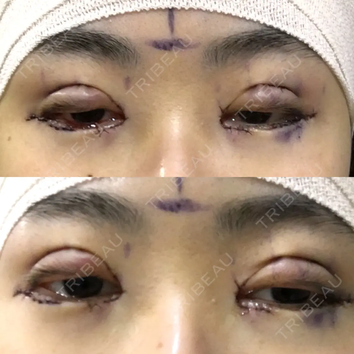 二重埋没 / 目頭切開 / 眼瞼下垂（切開） / タレ目形成・グラマラスライン（切開） / 目元修正 / その他（目元） シナジー整形外科 DAY 0