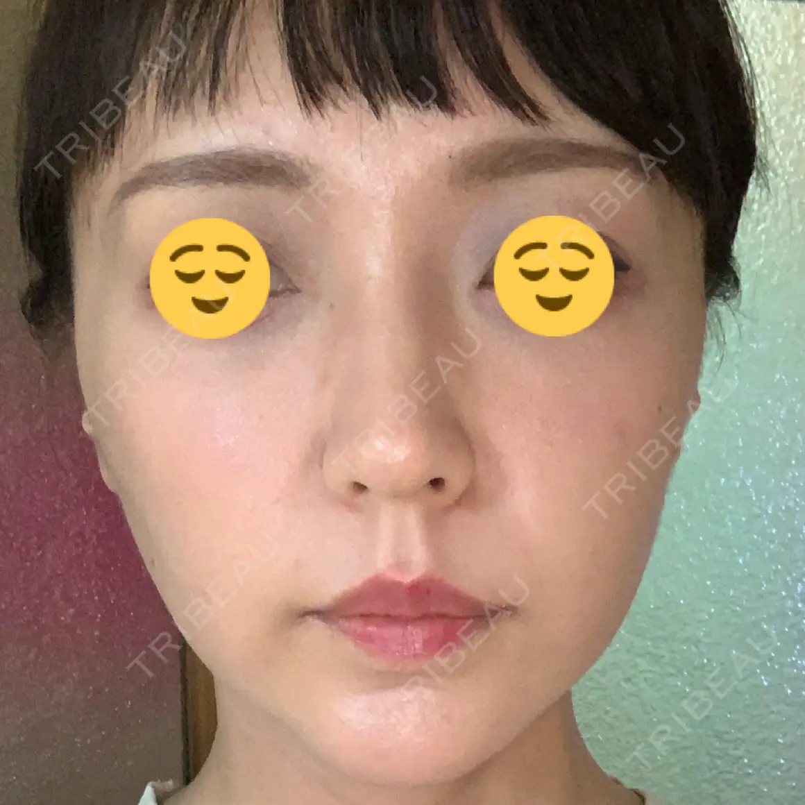 ハイフ（顔） / その他（輪郭） メイドユー皮膚科江南店 AFTER