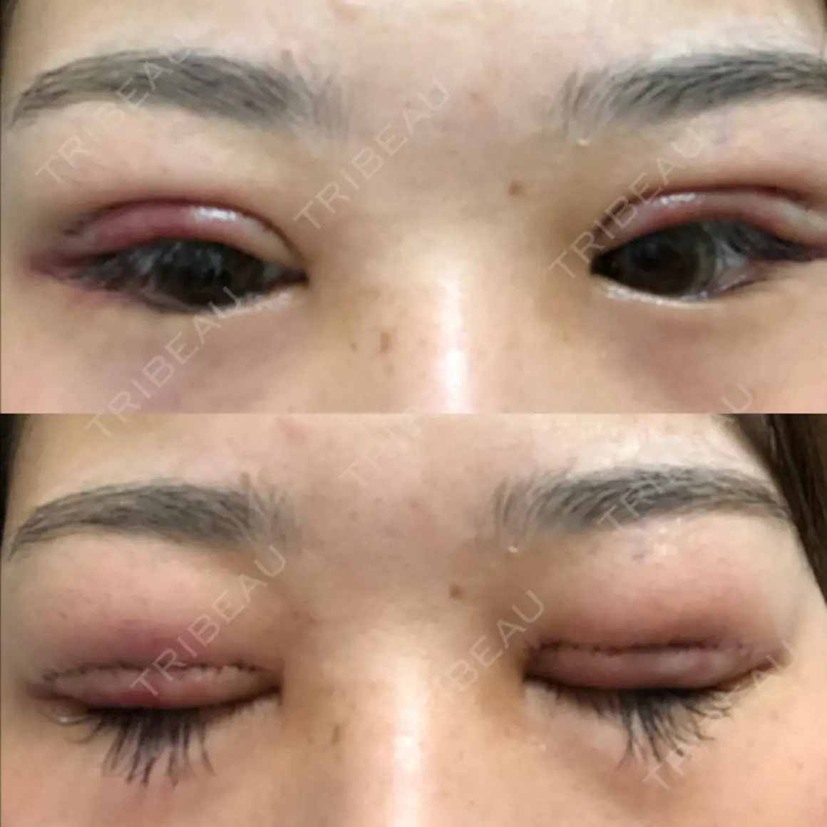 眼瞼下垂（切開） こんどう形成外科 DAY 1