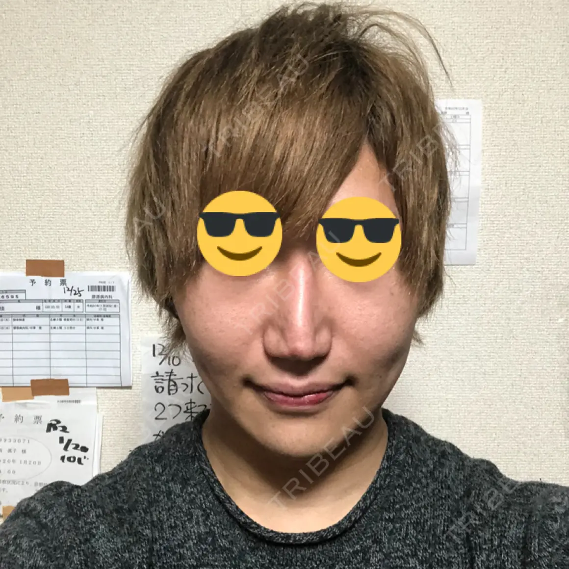 ハイフ（顔） abijouクリニック DAY 6