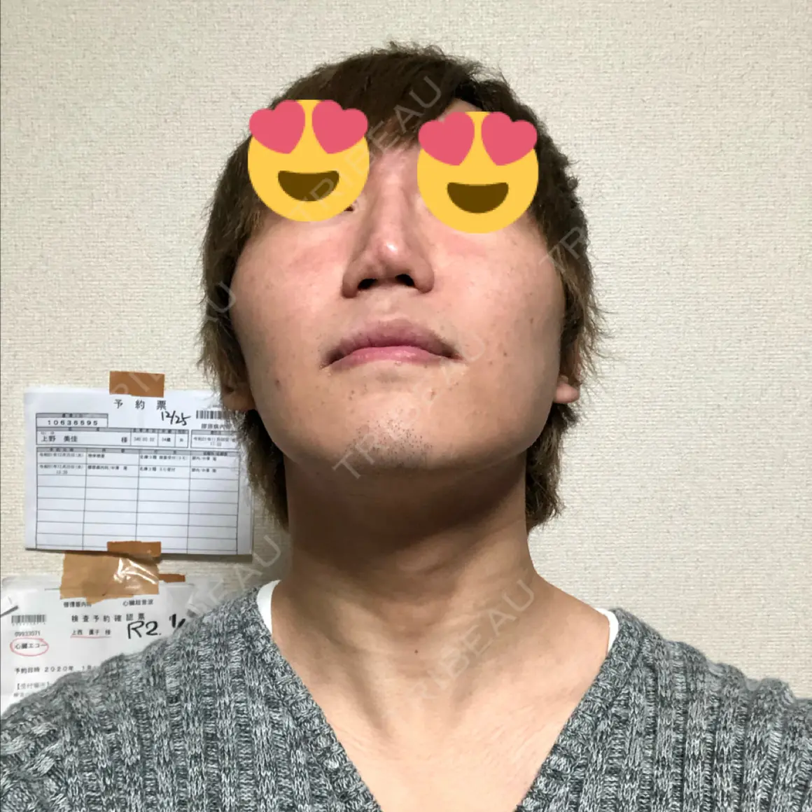 ハイフ（顔） abijouクリニック AFTER